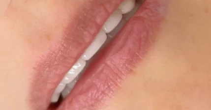 Контурная пластика губ